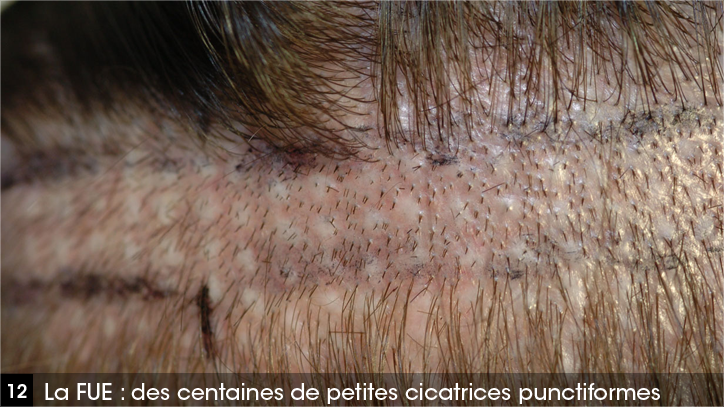 des centaines de petites cicatrices punctiformes sans cheveux, moins pigmentées que le reste du cuir chevelu